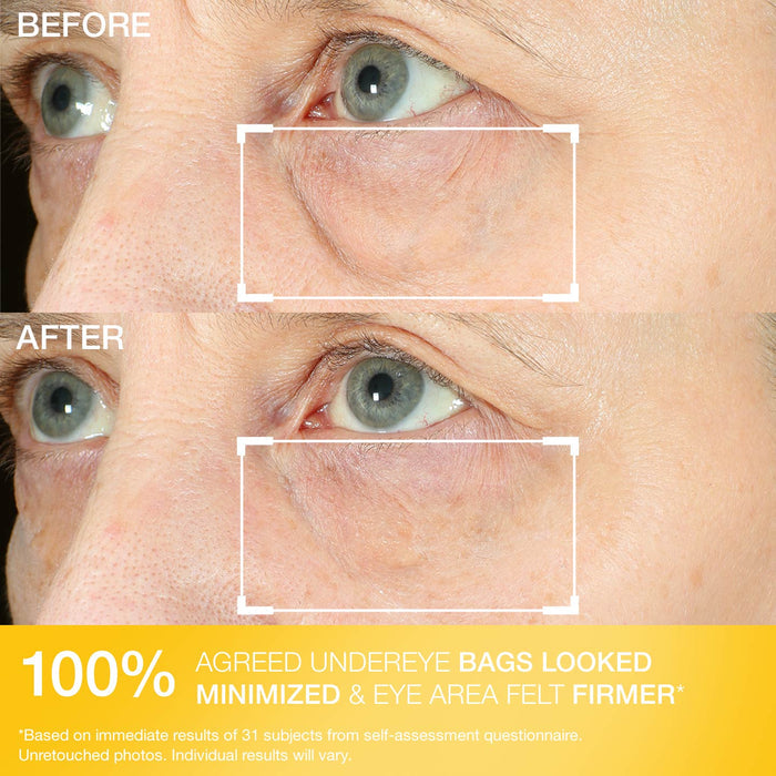 Hyperlift Eye® Instant Eye Fix