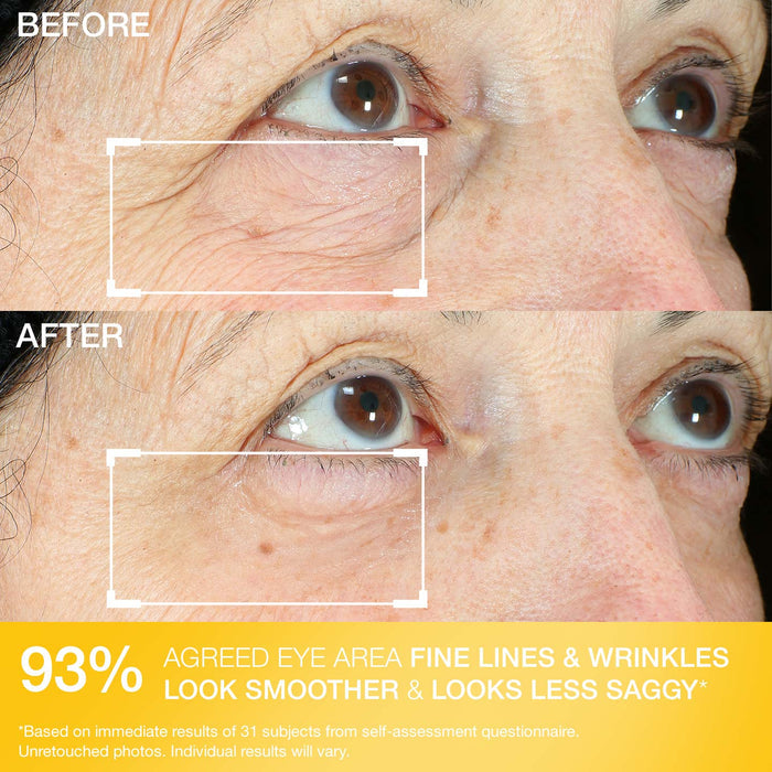 Hyperlift Eye® Instant Eye Fix